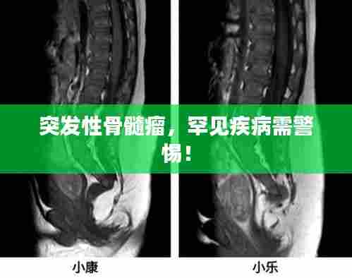 突发性骨髓瘤,罕见疾病需警惕!